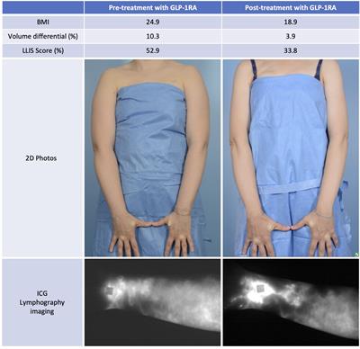 GLP-1 receptor agonist as an effective treatment for breast cancer-related lymphedema: a case report